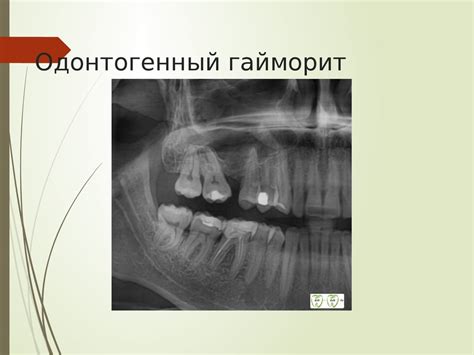 Одонтогенный гайморит. Клиника, диагностика, лечение. Перфорация и ...
