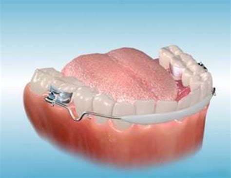 סילמט הפצה. LIP BUMPER-IDEAL GAC