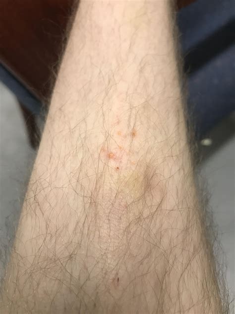 Is this crusted scabies? : r/scabies