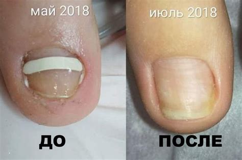 Вросший ноготь – как его правильно лечить? - Ваш Аптекар