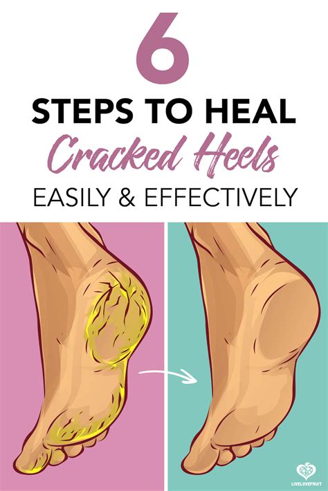 Follow These 6 Steps To Heal Cracked Heels Easily and Effectively