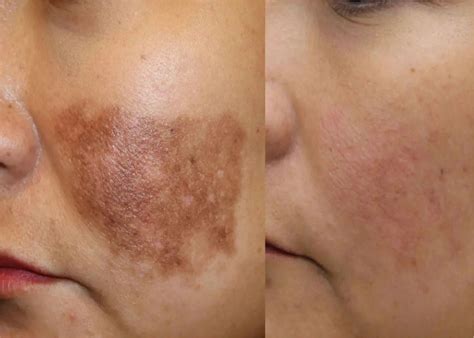 remove pigmentation  face permanently dermatouch