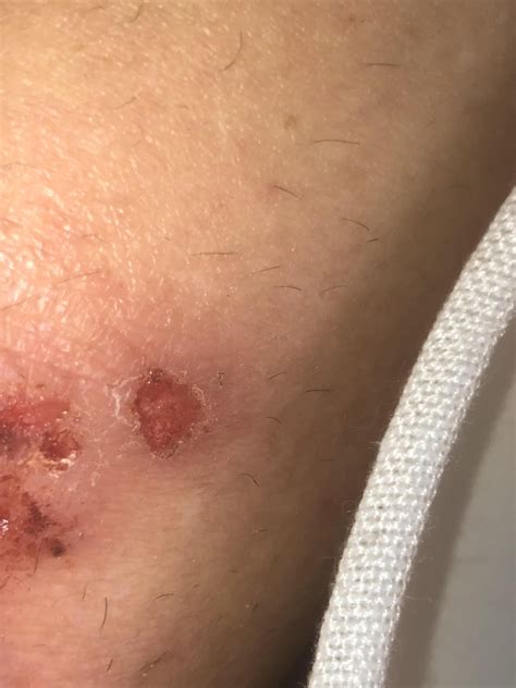 Folliculitis or atopic dermatitis??? : r/Folliculitis