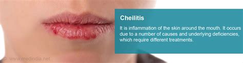 Cheilitis - Causes, Symptoms, Diagnosis & Treatment