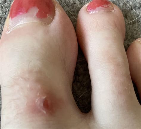 Wart? : r/Warts