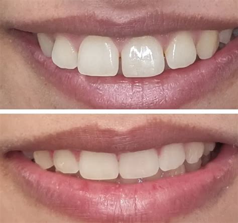 Clear aligners Before & After: Our Patients Speak For Us | Eon Aligner