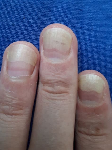 ongles striés, jaunis, décollés - Ongles - hervedu76 - Photos - Club ...