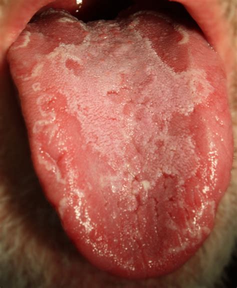 Geographic Tongue: Symptoms, Causes, Treatment – My Health and Fitness