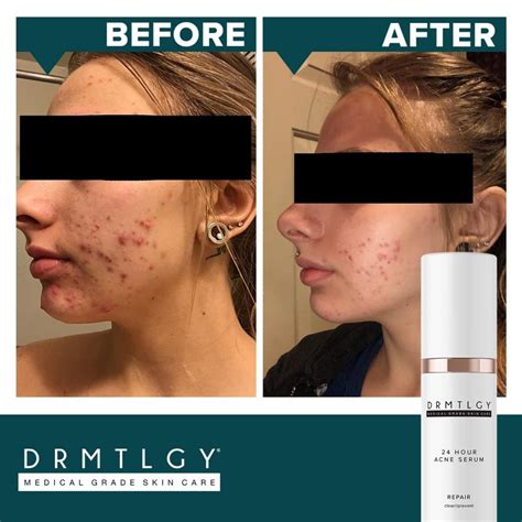 Drmtlgy Cystic Acne Treatment Is a Miracle for So Many Shoppers | Us Weekly