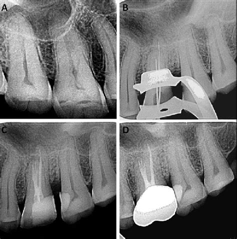 radiographs   left maxillary fi rst molar showing identical
