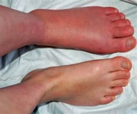 Complex Regional Pain Syndrome of Foot(CRPS) | Dr. Sampat Dumbre Patil
