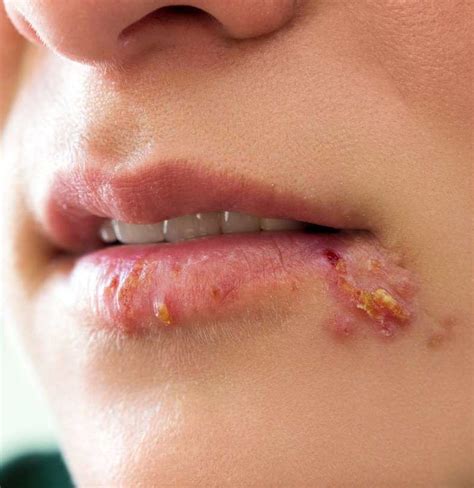 Herpes: Síntomas, causas y tratamiento - familydoctor.org🖖 Experimente ...