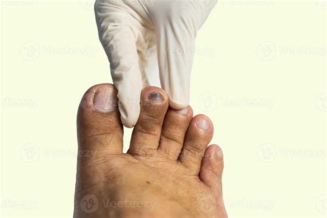 Toenail Subungual Hematoma 46587551 Stock Photo at Vecteezy