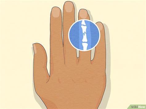 determine   finger  broken symptoms