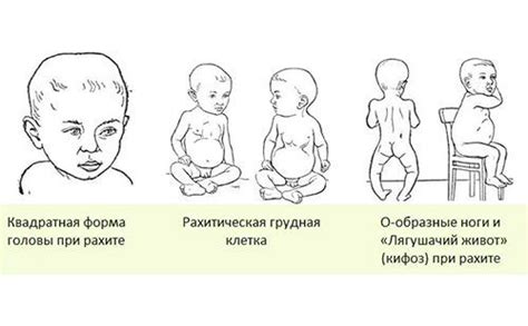 Дефицит витамина D: причины, симптомы и лечение в статье эндокринолога ...