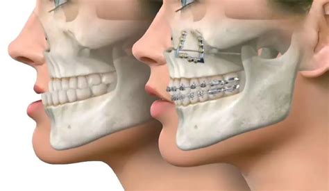jaw surgery orthognathic surgery thomson medical