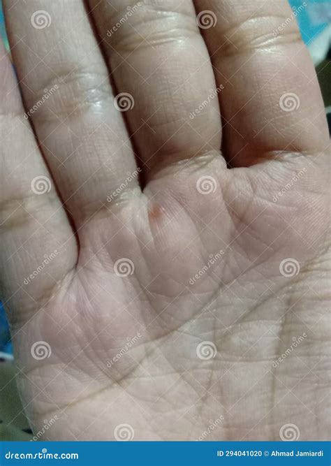 The Palms are Sore and Red. Stock Photo - Image of chest, human: 294041020