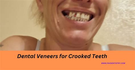 Dental Veneers for Crooked Teeth: Your Ultimate Solution for a Flawless ...