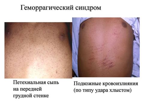 Конго-крымская геморрагическая лихорадка. Клинические аспекты ...