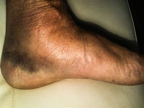 My rehabilitation from an Achilles Tendon tear..: My rehabilitation ...