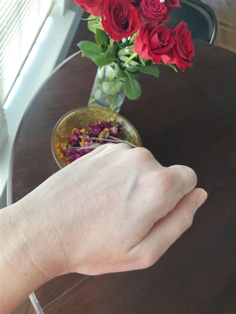 My hands today : r/scabies
