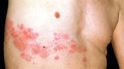 Le zona : quand le virus de la varicelle se réveille