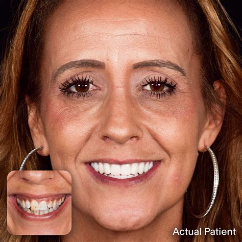 Full Mouth Dental Implants Dallas, TX | Doctors Implants