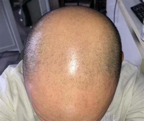 What are these pimples on my scalp and how to treat them ? : r/acne