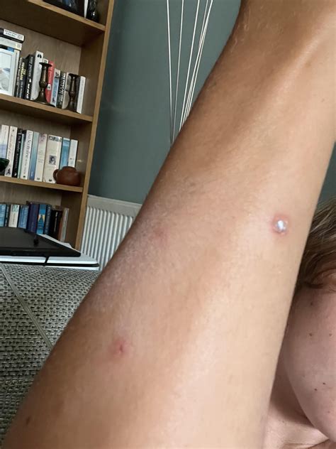 Unexplained spreading blisters on arms and legs : r/DermatologyQuestions