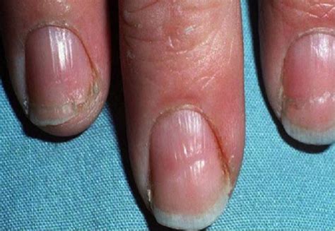 Pin by Leslie on thyroid in 2020 | Nails, Health, Healthy nails