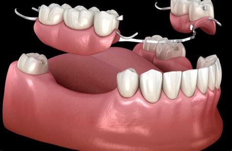 design  removable partial dentures