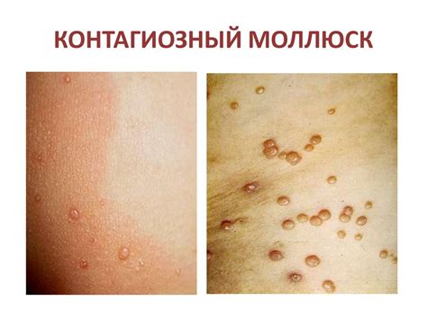 Вирусные заболевания кожи - презентация онлайн