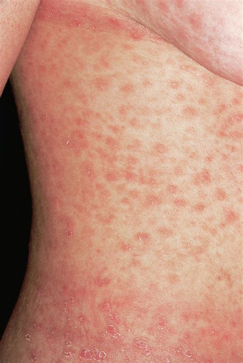 Syphilis Face Rash