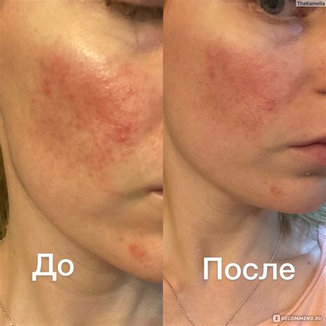 Маска для лица SeSDERMA Azelac - «Azelac маска - новинка от Sesderma ...
