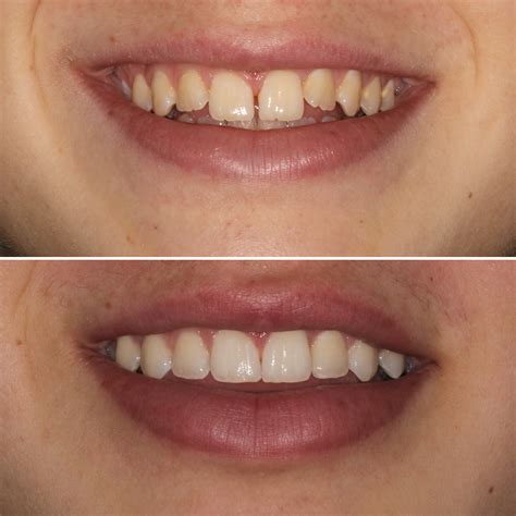 Direct Resin Veneers - Studio City, CA | Dr. Jamie Sands