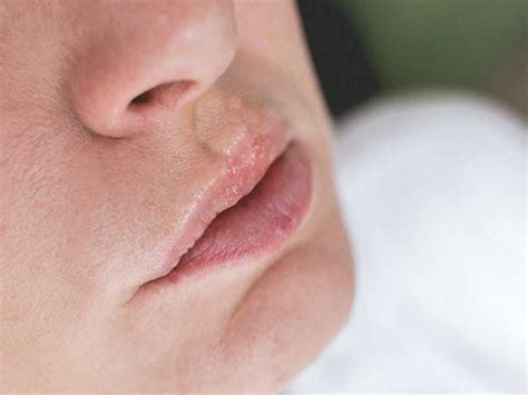 Swelling Lips And Hives | Sitelip.org