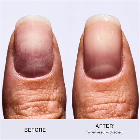 Reasons Why Fingernails Fall Off