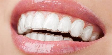 Transformative Aligners Before and After