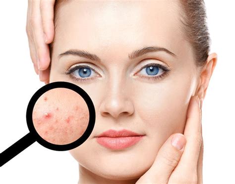 Acne Diagnosis and Treatment | Dermatologists located in Coraopolis, PA ...