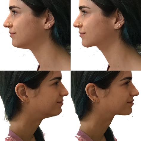 How can I get rid of this excess under chin flab? Chin augmentation? I