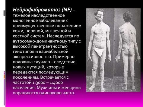 Нейрофиброматоз - презентация онлайн