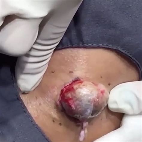 Cyst Popping