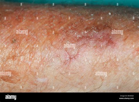 skin atrophy