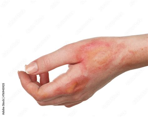 Horrible burns on female hand isolated on white Stock Photo | Adobe Stock