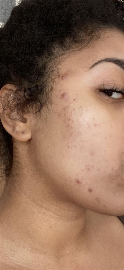 Before and after microdermabrasion : r/SkincareAddictionUK