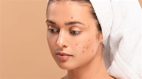 Acne: Causes, Types, and Treatments | Sozo Clinic