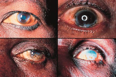 Onchocerciasis examples - Africa Health