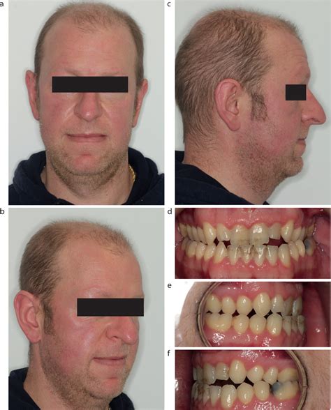 Frontal Bossing Acromegaly