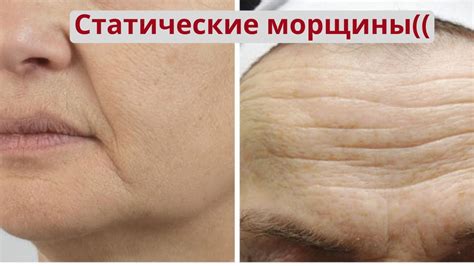 Статические морщины. Почему появляются морщины и как убрать статические ...