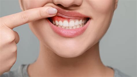 Stomatită: Cauze, tipuri și tratament - LLL Dental